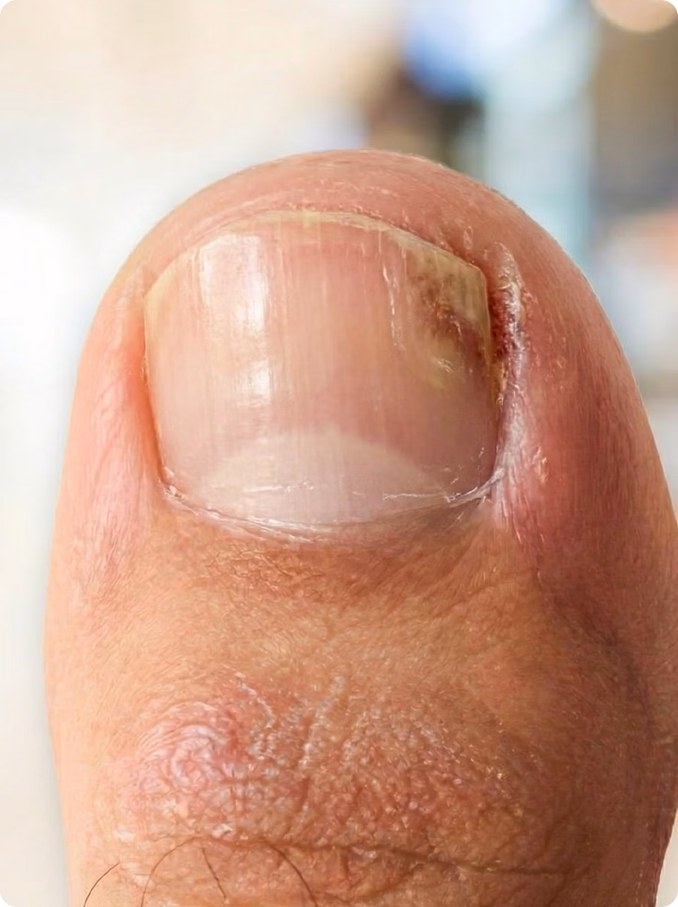 Orivelle nail-care visual